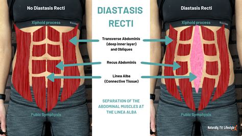 how to identify diastasis recti